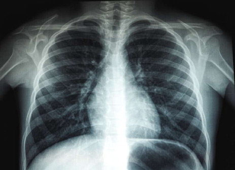 Image for Implementation of Masked Autoencoders Vision Learners on a medical chest X-Ray Images
