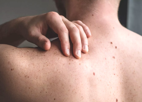 Image for Skin Lesions Classification